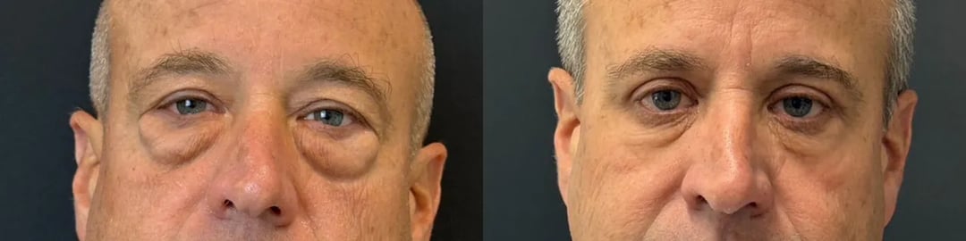 Front View Upper &Amp; Lower Bleph Before And After Photos By Dr. Demetri Arnaoutakis In Tampa, Fl