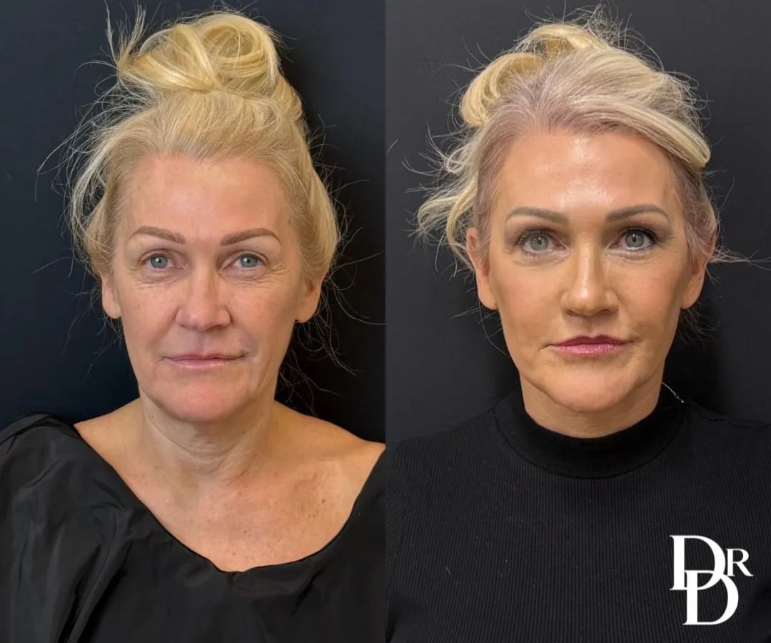 Front View Facelift Before And After Photos By Dr. Demetri