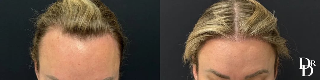 Front View Hair Transplant Before And After Photos By Dr. Demetri