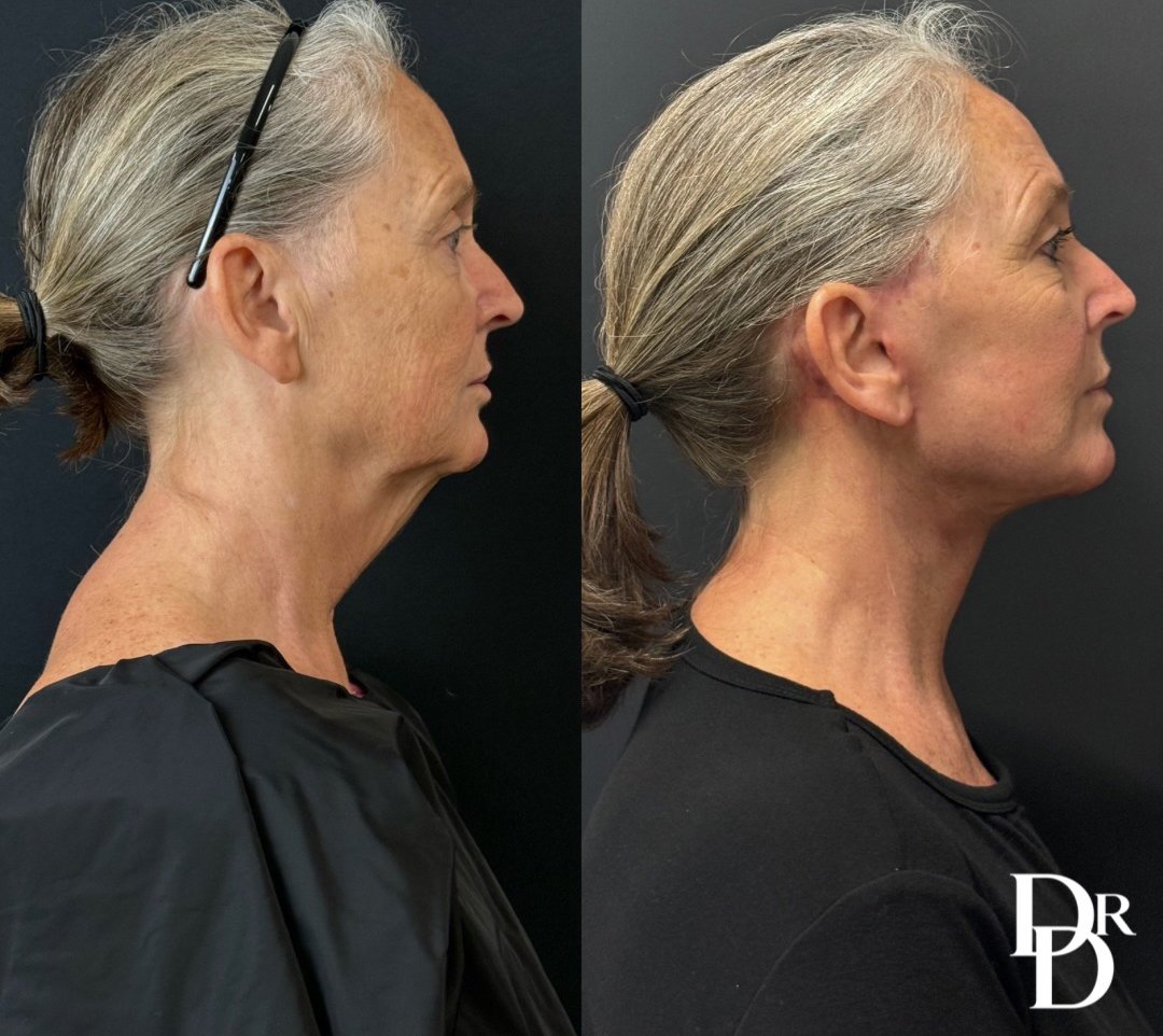 Right Side View Facelift Before And After Photos By Dr. Demetri