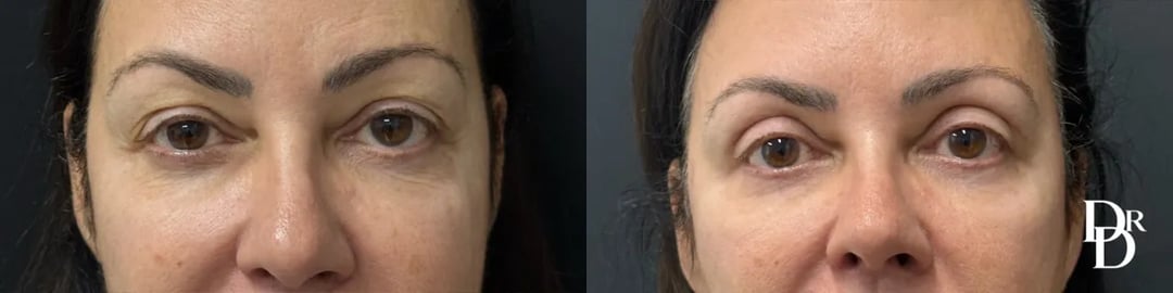 Front View Upper Blepharoplasty Before And After Photos By Dr. Demetri