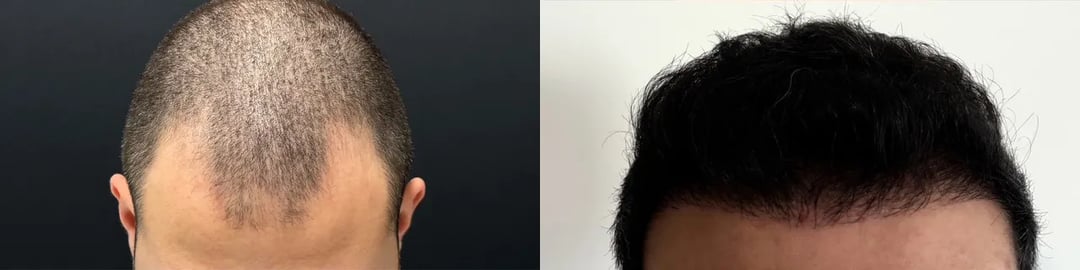 Hair Transplant Before And After Photo By Dr. Demetri