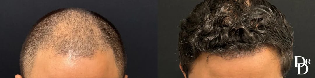 Hair Transplant Before And After Photo By Dr. Demetri