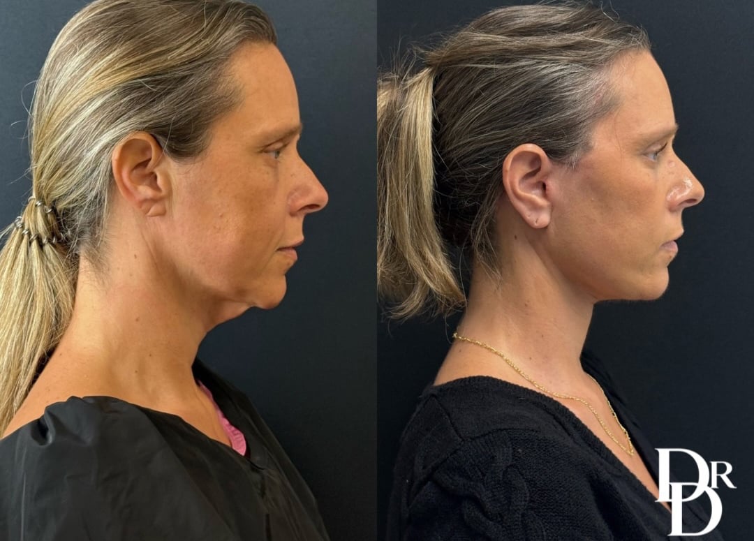 Right Side View Facelift Before And After Photos By Dr. Demetri