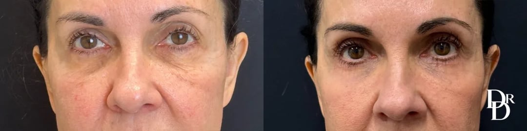 Front View Lower Blepharoplasty Before And After Photos By Dr. Demetri
