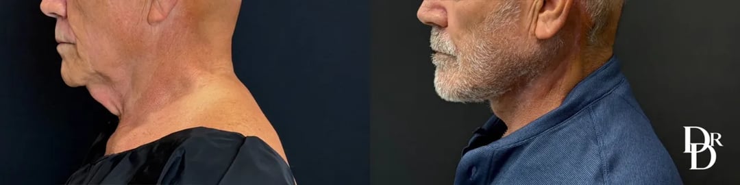 Left Side View Neck Lift Before And After Photos By Dr. Demetri