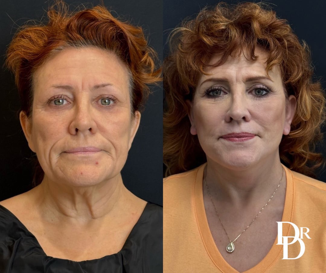 Front View Facelift Before And After Photos By Dr. Demetri