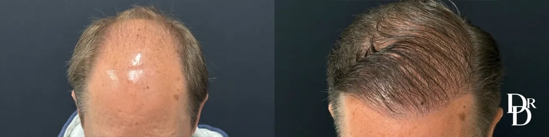 Hair Transplant Before And After Photo By Dr. Demetri