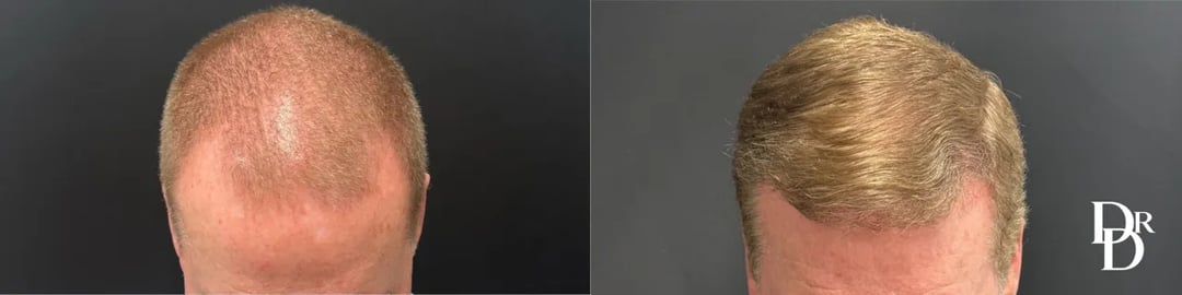 Hair Transplant Before And After Photo By Dr. Demetri