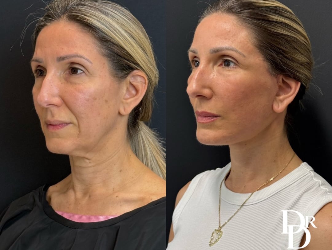 Left Oblique View Facelift Before And After Photos By Dr. Demetri