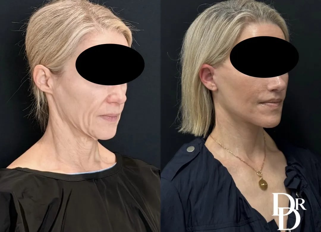 Right Oblique View Facelift Before And After Photo By Dr. Demetri
