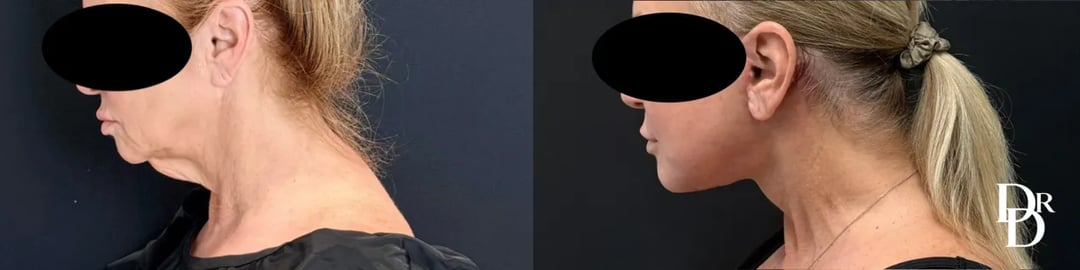 Left Side View Face And Neck Lift Before And After Photo By Dr. Demetri
