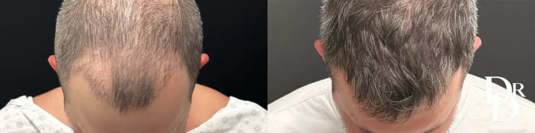 Head Down View Hair Transplant Before And After Photo By Dr. Demetri