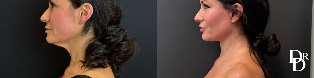 Left Side View Neck Lift Before And After Photo By Dr. Demetri