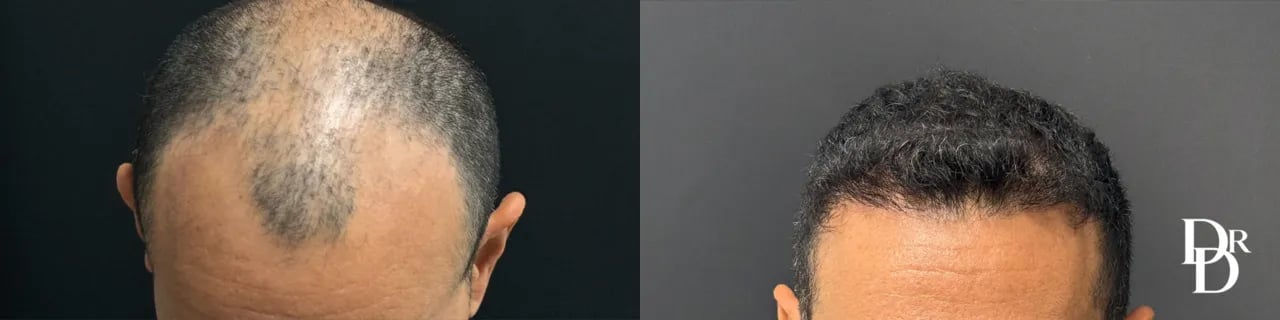 Front View Hair Transpalnt Before And After Photos By Dr. Demetri Front View Hair Transpalnt Before And After Photos By Dr. Demetri