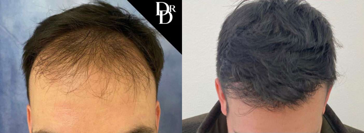 Hair Transplant Before And After Photos By Dr. Demetri Arnaoutakis In Tampa, Fl Hair Transplant Before And After Photos By Dr. Demetri Arnaoutakis In Tampa, Fl