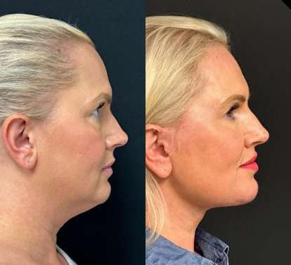 Neck Lift Before And After Photos By Dr. Demetri Arnaoutakis In Tampa, Fl