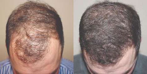 Hair Transplant Before And After Photos By Dr. Demetri Arnaoutakis In Tampa, Fl