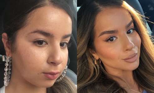 Buccal Fat Pad Removal Before And After Photos By Dr. Demetri Arnaoutakis In Tampa, Fl