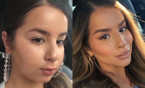 Case# Buccal Fat Pad Removal Before And After Photos By Dr Demetri Arnaoutakis In Tampa Fl Case# Buccal Fat Pad Removal Before And After Photos By Dr Demetri Arnaoutakis In Tampa Fl
