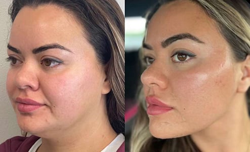 Case# Buccal Fat Pad Removal Before And After Photos By Dr Demetri Arnaoutakis In Tampa Fl Case# Buccal Fat Pad Removal Before And After Photos By Dr Demetri Arnaoutakis In Tampa Fl