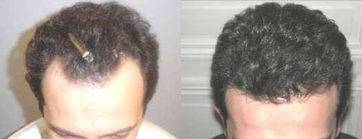 Hair Transplant Before And After Photos By Dr. Demetri Arnaoutakis In Tampa, Fl