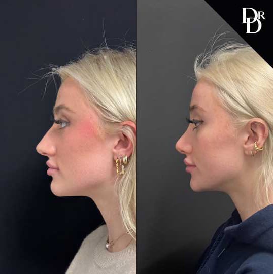 Rhinoplasty Before And After Photos By Dr. Demetri Arnaoutakis In Tampa, Fl