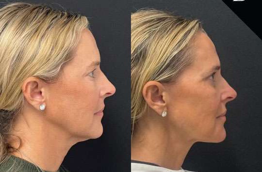 Facetite Before And After Photos By Dr. Demetri Arnaoutakis In Tampa, Fl