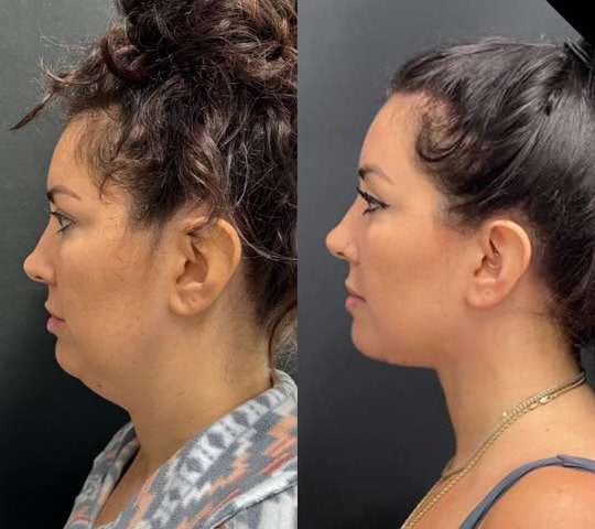 Neck Lift Before And After Photos By Dr. Demetri Arnaoutakis In Tampa, Fl