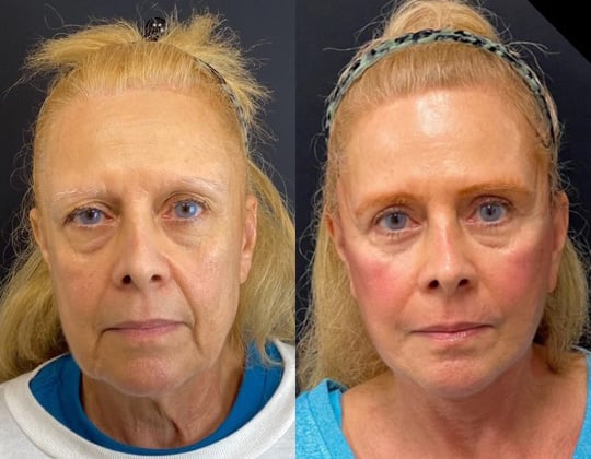 Neck Lift Before And After Photos By Dr. Demetri Arnaoutakis In Tampa, Fl