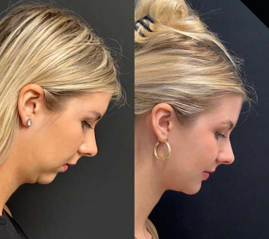 Neck Lift Before And After Photos By Dr. Demetri Arnaoutakis In Tampa, Fl