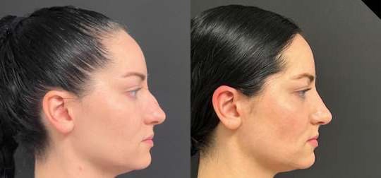 Rhinoplasty Before And After Photos By Dr. Demetri Arnaoutakis In Tampa, Fl