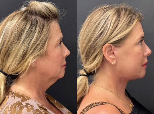 Neck Lift Before And After Photos By Dr. Demetri Arnaoutakis In Tampa, Fl