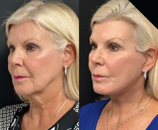 Neck Lift Before And After Photos By Dr. Demetri Arnaoutakis In Tampa, Fl