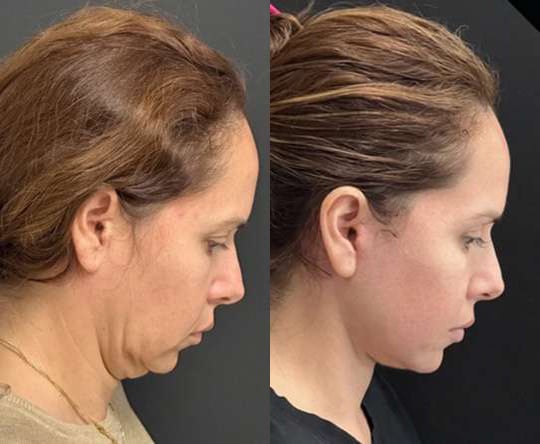 Neck Lift Before And After Photos By Dr. Demetri Arnaoutakis In Tampa, Fl
