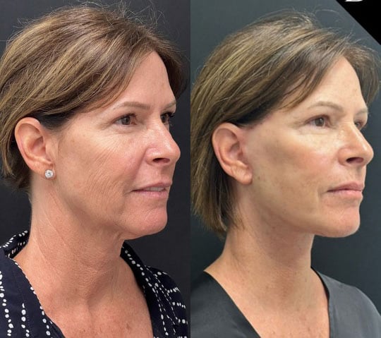 Neck Lift Before And After Photos By Dr. Demetri Arnaoutakis In Tampa, Fl