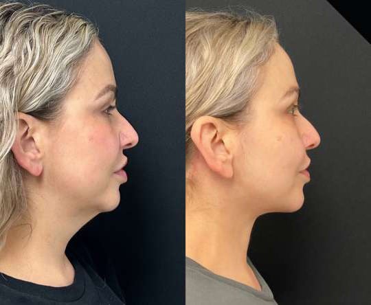 Neck Lift Before And After Photos By Dr. Demetri Arnaoutakis In Tampa, Fl