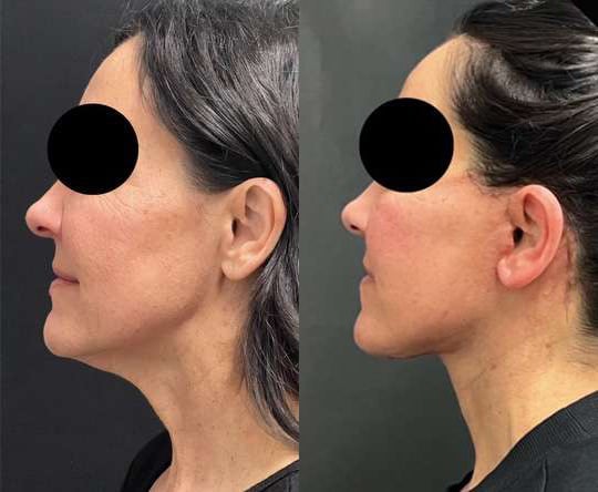 Neck Lift Before And After Photos By Dr. Demetri Arnaoutakis In Tampa, Fl