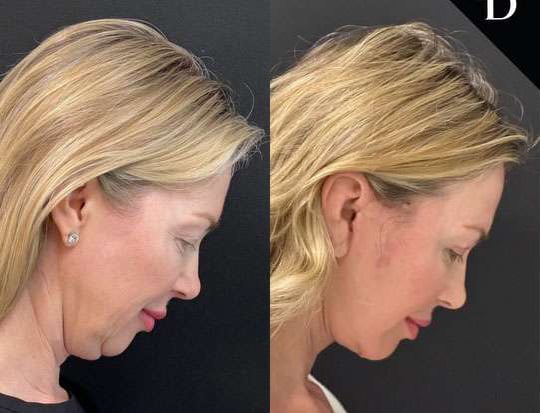 Neck Lift Before And After Photos By Dr. Demetri Arnaoutakis In Tampa, Fl