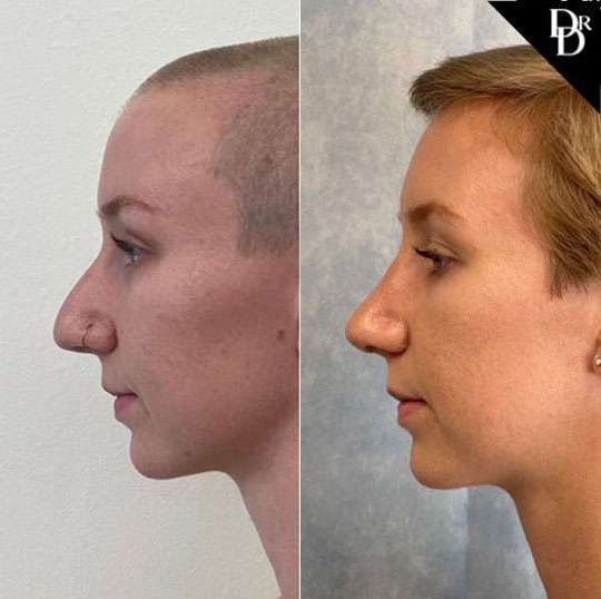 Rhinoplasty Before And After Photos By Dr. Demetri Arnaoutakis In Tampa, Fl