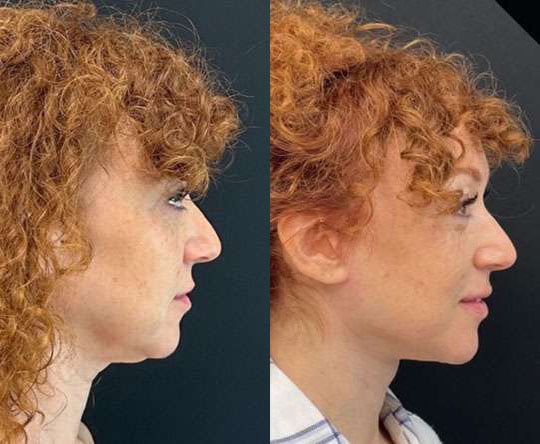 Neck Lift Before And After Photos By Dr. Demetri Arnaoutakis In Tampa, Fl