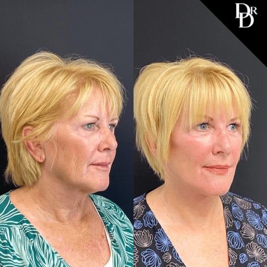 Facelift Before And After Photos By Dr. Demetri Arnaoutakis In Tampa, Fl
