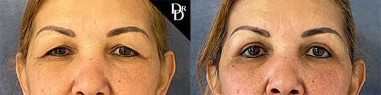 Brow Lift Before And After Brow Lift Before And After