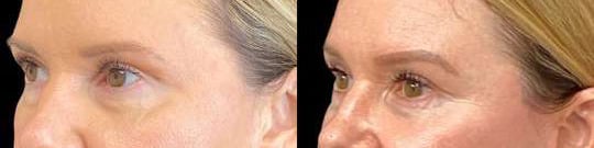 Brow Lift Before And After Brow Lift Before And After