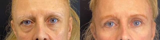 Brow Lift Before And After Brow Lift Before And After
