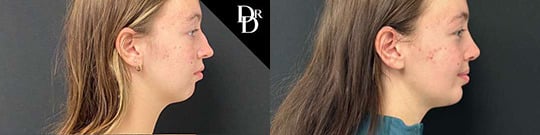 Chin Augmentation Before And After Chin Augmentation Before And After