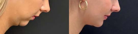 Chin Augmentation Before And After Chin Augmentation Before And After