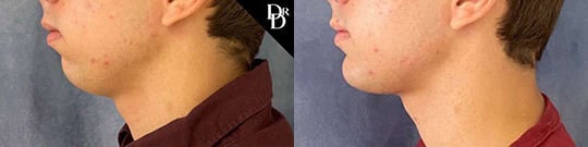 Chin Augmentation Before And After Chin Augmentation Before And After