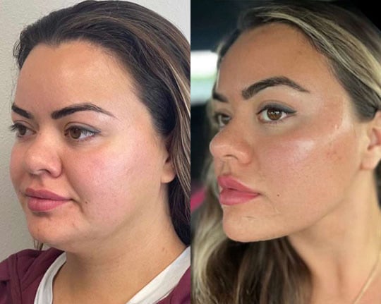 Deep Neck Lift Before After Deep Neck Lift Before After