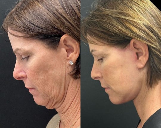 Deep Plane Facelift Before After () Deep Plane Facelift Before After ()